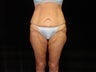 Body Lift with Liposuction of Abdomen, Waist, and Flanks