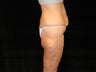 Body Lift with Liposuction of Abdomen, Waist, and Flanks