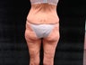 Body Lift with Liposuction of Abdomen, Waist, and Flanks