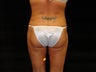 Liposuction