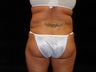 Liposuction