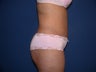 Tummy tuck