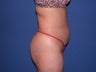 Tummy tuck