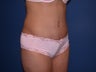 Tummy tuck