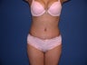 Tummy tuck