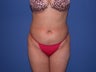 Tummy tuck