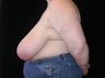 Breast reduction