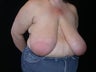Breast reduction