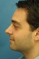Rhinoplasty