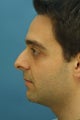 Rhinoplasty