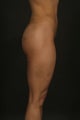Brazilian Butt Lift