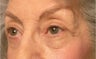 Eyelid Surgery
