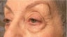 Eyelid Surgery