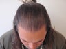 Hair Transplant