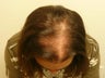 Hair Transplant