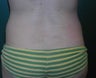 Liposuction