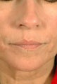 Juvederm for Mouth Rejuvenation 