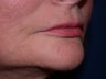 Injectable Fillers