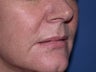 Injectable Fillers