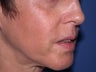 Injectable Fillers
