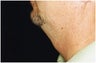 Chin Implant