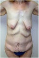 Body Lift