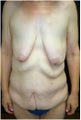 Body Lift