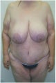 Body Lift Following Extreme Weight-Loss