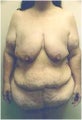 Body Lift Following Extreme Weight-Loss