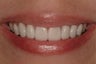 Porcelain Veneers
