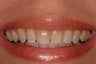 Porcelain Veneers