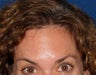 Botox