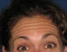 Botox