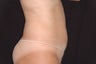 Body Jet Lipo for Abdomen in Florida