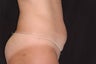 Body Jet Lipo for Abdomen in Florida