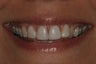Porcelain Veneers