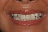 Invisalign
