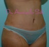 Tummy Tuck