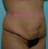 Tummy Tuck