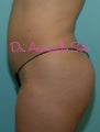 Brazilian Butt Lift