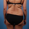 Liposuction