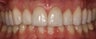 Porcelain crowns and veneers and whitening... One day Fabrication!