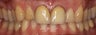Porcelain crowns and veneers and whitening... One day Fabrication!