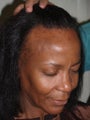 Hairline Advancement