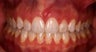 Invisalign
