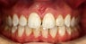 Invisalign