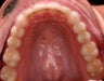 Invisalign