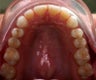 Invisalign