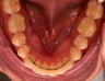 Invisalign