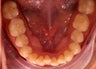 Invisalign
